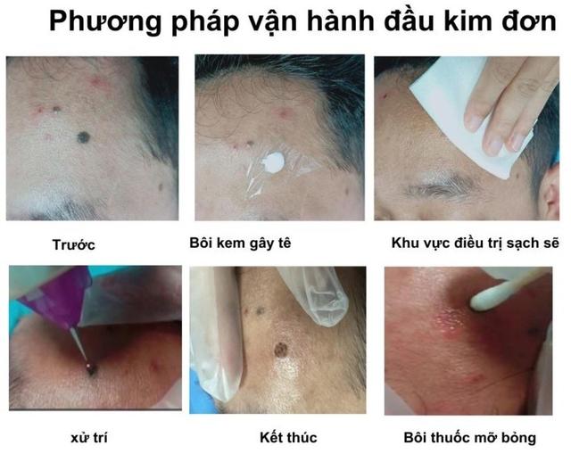 Hướng dẫn sử dụng máy Plasma Gold trong làm đẹp trị sẹo hiệu quả tối ưu - Ảnh 18.