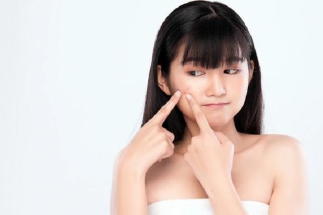 Trioderma - giải pháp chăm sóc da dầu mụn cho tuổi teen hiệu quả và an toàn - Ảnh 1.