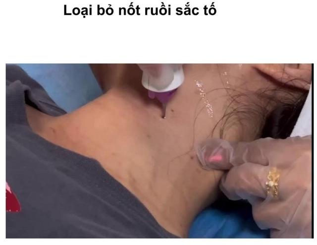 Hướng dẫn sử dụng máy Plasma Gold trong làm đẹp trị sẹo hiệu quả tối ưu - Ảnh 19.