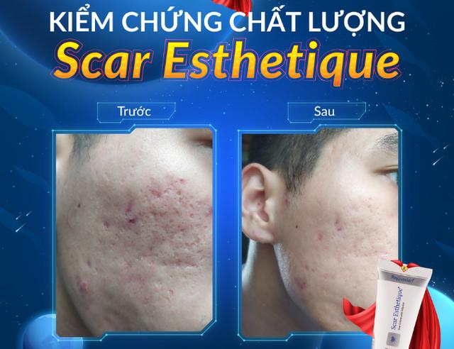 Không laser, không kim: Giải pháp khoa học bôi thoa cho sẹo rỗ mụn  - Ảnh 4.