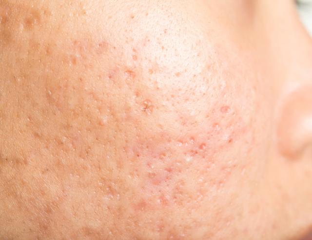 Sẹo không chỉ ảnh hưởng thẩm mỹ mà còn sức khỏe tinh thần- Ảnh 3.