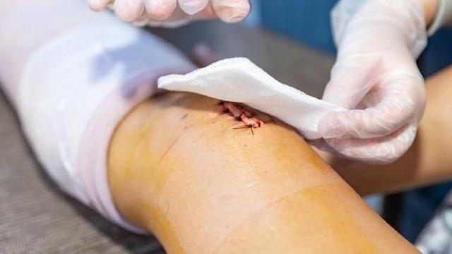 HemaHeal - Thêm một giải pháp ngăn tái nhiễm trùng trong chăm sóc vết thương hiện đại - Ảnh 3.