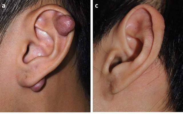 [Review nhanh] Top 5 cách trị sẹo lồi đang được thực hiện nhiều hiện nay- Ảnh 3.