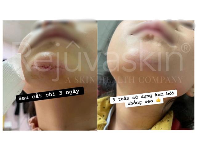 Silicone y tế: Phòng thí nghiệm đến phòng mổ - Hành trình công nghệ kiểm soát sẹo   - Ảnh 3.