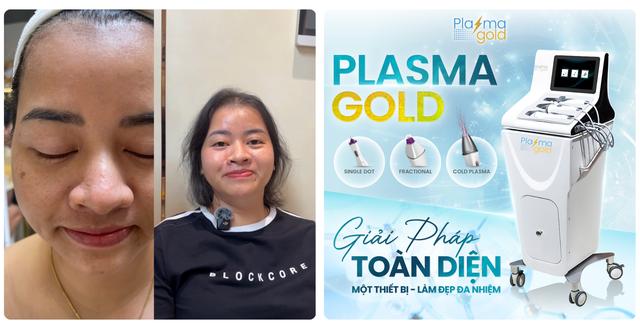Review chân thực máy Plasma Gold có thật sự đáng để spa, thẩm mỹ viện đầu tư? - Ảnh 6.