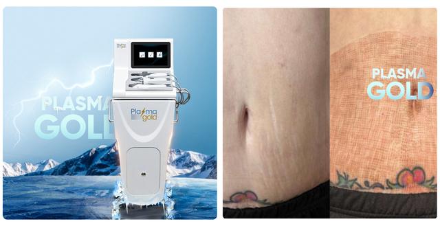 Review chân thực máy Plasma Gold có thật sự đáng để spa, thẩm mỹ viện đầu tư? - Ảnh 8.
