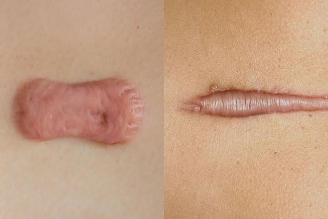 Scar FX & Rejuvasil khác gì so với các giải pháp chăm sóc sẹo thông thường? - Ảnh 1.