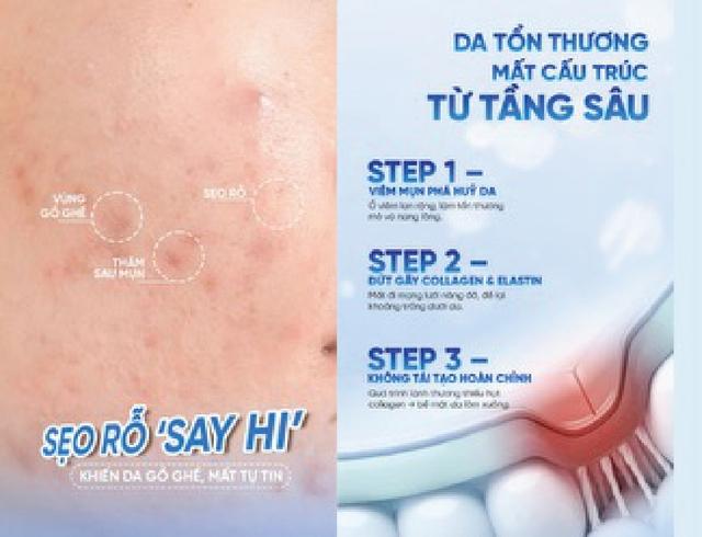 Đừng để sẹo mụn kéo lùi bạn, chăm da đẹp, tự tin trở lại, cơ hội đến- Ảnh 1.