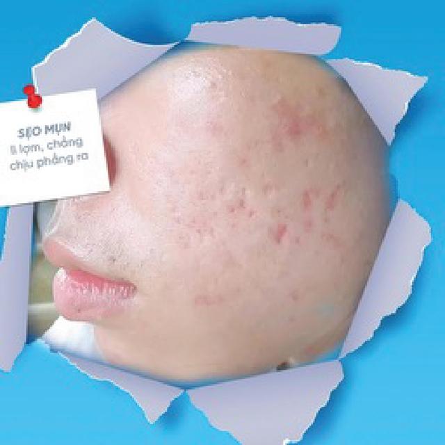 Đừng để sẹo mụn kéo lùi bạn, chăm da đẹp, tự tin trở lại, cơ hội đến- Ảnh 2.