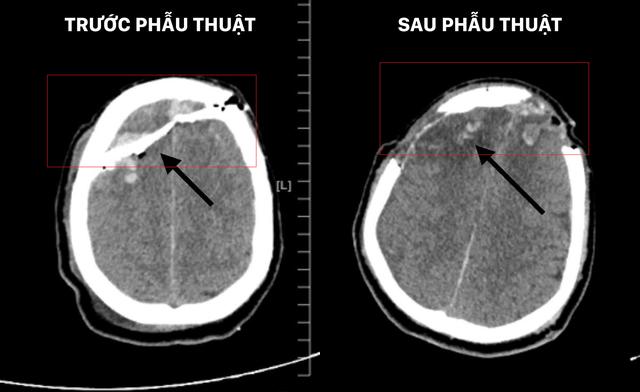 Vỡ sọ, dập não sau xô xát, nam thanh niên được cứu sống đầy ngoạn mục - Ảnh 2.