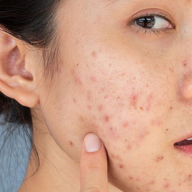 Cải thiện thâm mụn trong 4 tuần với một bước chăm da cuối cùng - Ảnh 1.
