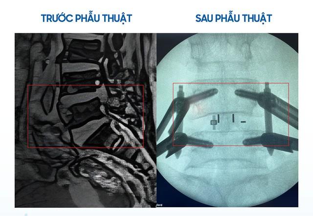 Mổ cột sống cứu người cao tuổi nhiều bệnh nền khỏi nguy cơ liệt chân vĩnh viễn - Ảnh 3.