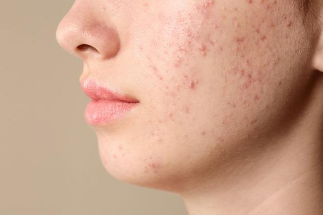 Vì sao Scar Esthetique là sản phẩm dành cho thâm đỏ sau mụn? - Ảnh 1.