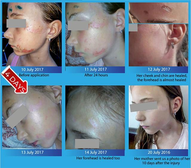 Khi nào nên chọn Hema để chăm sóc vết thương?- Ảnh 3.
