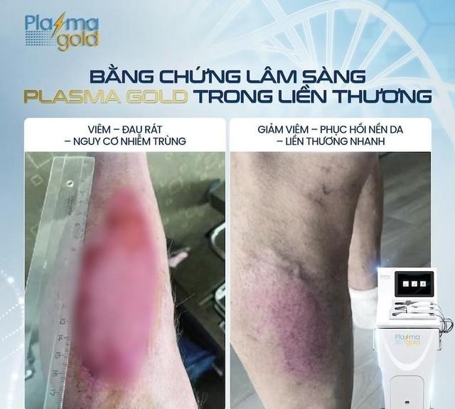 Plasma Gold - Từ phục hồi vết thương đến chuẩn mực thẩm mỹ cao cấp- Ảnh 3.