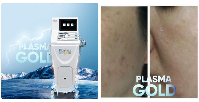 Plasma Lạnh trị sẹo rỗ và se khít lỗ chân lông như thế nào?- Ảnh 5.