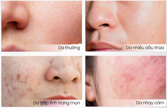 Top 9 sữa rửa mặt ngừa mụn sạch sâu mà không khô da, ai dùng cũng mê! - Ảnh 5.