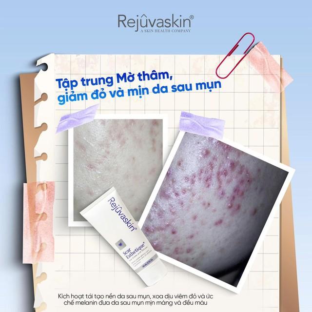 Skincare phục hồi da sau mụn tốt ngừa sẹo rỗ thâm đỏ sau 8 tuần- Ảnh 5.