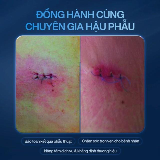 Công nghệ Plasma Lạnh: Lựa chọn hàng đầu của spa, clinic cho làn da đẹp! - Ảnh 7.