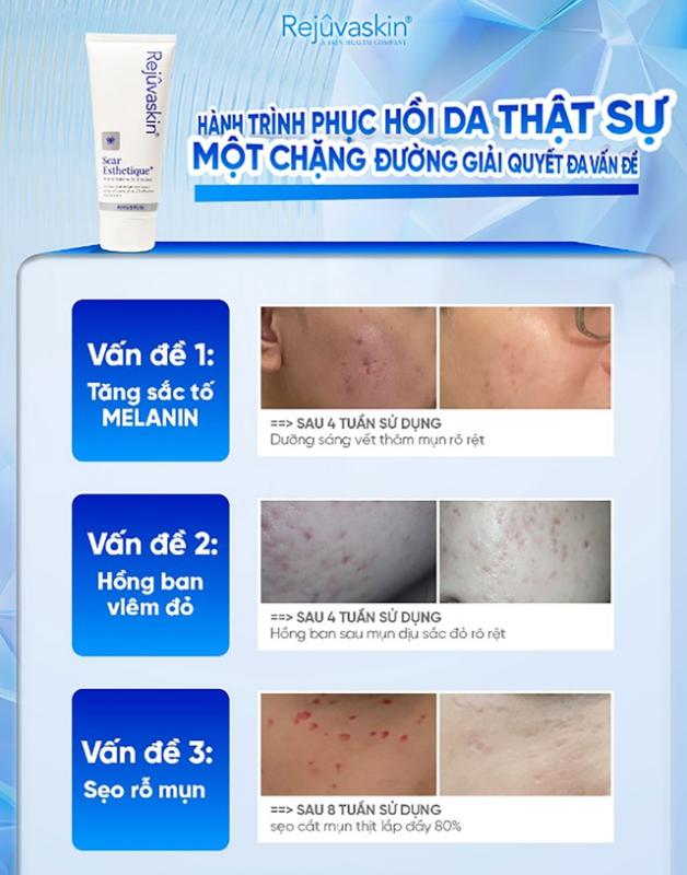 Sử dụng kem mờ sẹo chuẩn y khoa hiệu quả tăng gấp 3 ngừa tái phát- Ảnh 8.