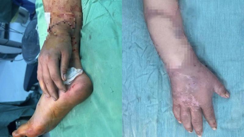 Bệnh viện đa khoa Bình Dương nối lại bàn tay đứt lìa cho thai phụ- Ảnh 1.