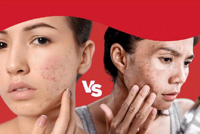 Hết thâm đỏ sau mụn nhanh: Cách chọn sản phẩm chuẩn khoa học- Ảnh 1.