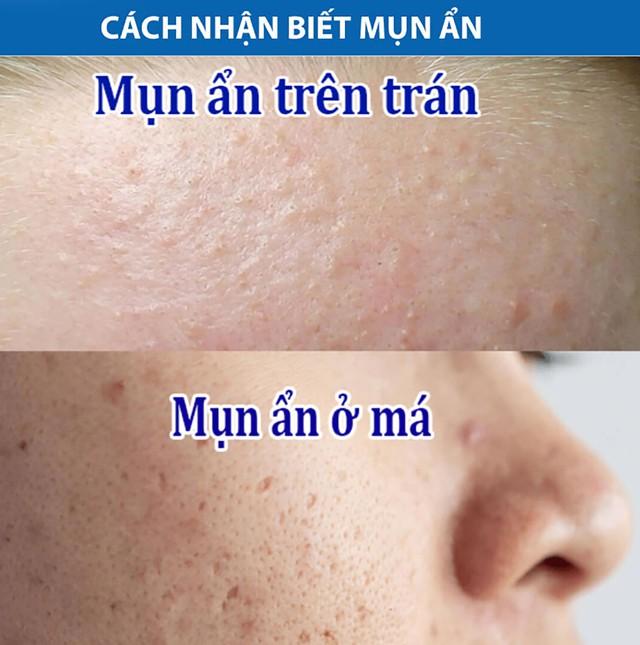 Bất ngờ chưa: Trioderma ngừa mụn ẩn hiệu quả đến mức chuyên gia cũng phải công nhận!- Ảnh 2.