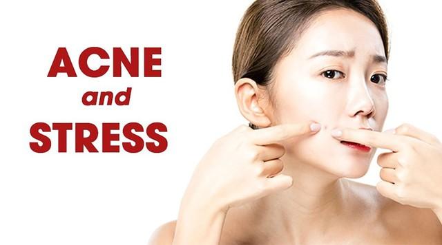 Ghim ngay cách cải thiện mụn tại nhà đơn giản mà hiệu quả, ngừa tái phát- Ảnh 2.