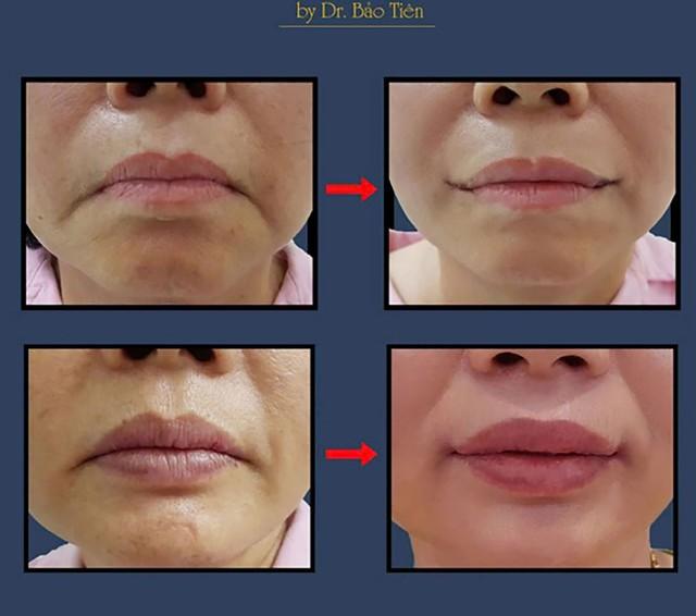 Smile Lipt bí quyết tạo khóe môi cười tự nhiên của bác sĩ Bảo Tiên- Ảnh 2.