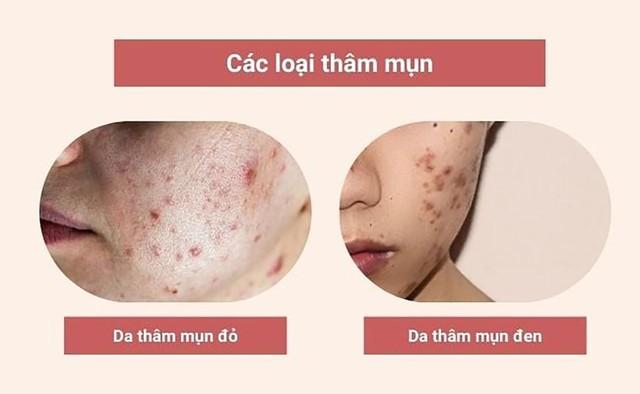 Mụn thâm đen cứng đầu, lâu năm cải thiện bật sáng đều màu sau 7 ngày- Ảnh 2.