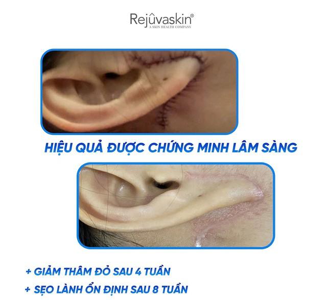 Cách sử dụng gel Rejuvasil chuẩn chuyên gia giúp sẹo lồi mờ nhanh đến bất ngờ - Ảnh 3.