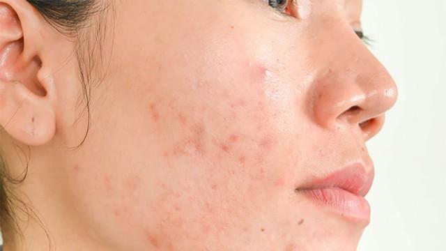 Ghim ngay cách cải thiện mụn tại nhà đơn giản mà hiệu quả, ngừa tái phát- Ảnh 3.