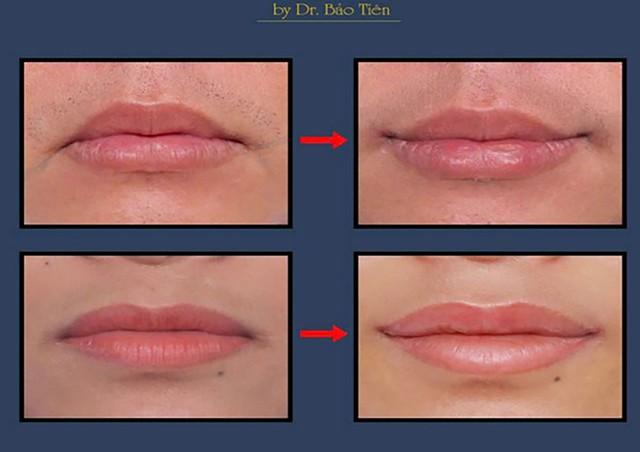 Smile Lipt bí quyết tạo khóe môi cười tự nhiên của bác sĩ Bảo Tiên- Ảnh 3.
