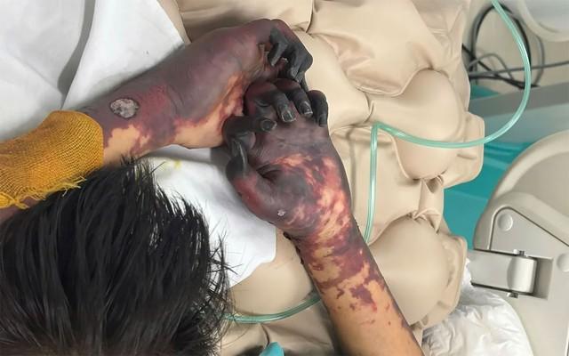 Nỗi đau người mẹ khi con trai cầu thủ cắt bỏ chân vì bệnh não mô cầu - Ảnh 4.