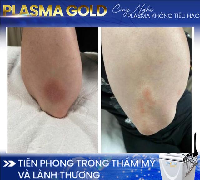 Cold Plasma - Công nghệ tiên tiến trong phục hồi phẫu thuật tạo hình - Ảnh 4.