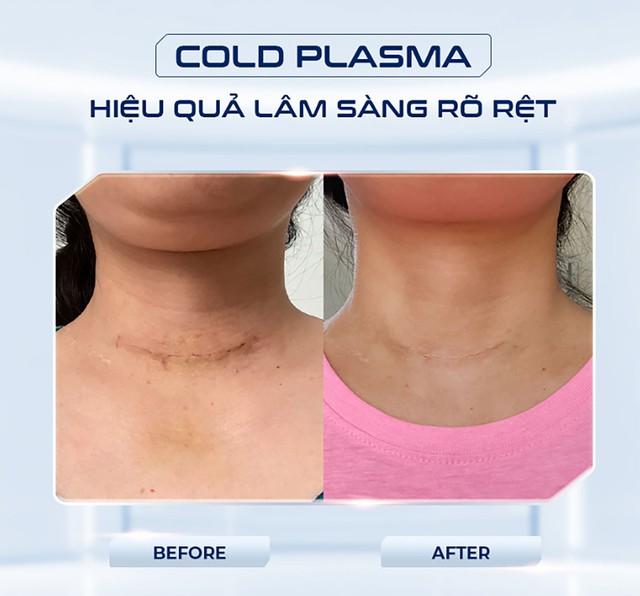 Máy Plasma Lạnh là gì? Công dụng của Plasma Lạnh trong thẩm mỹ?- Ảnh 4.