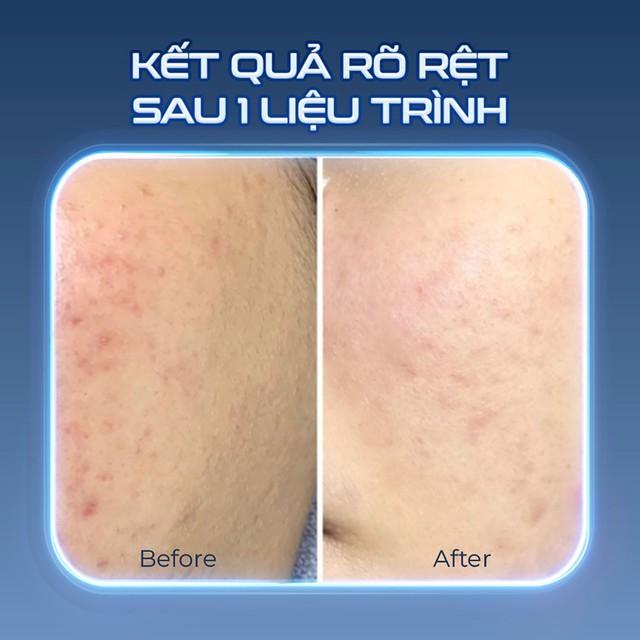 Máy Plasma Lạnh là gì? Công dụng của Plasma Lạnh trong thẩm mỹ?- Ảnh 5.