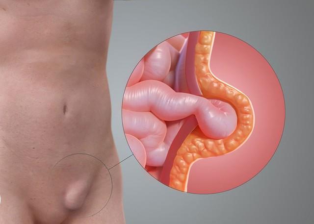 Người đàn ông 51 tuổi suýt gặp biến chứng nguy hiểm vì khối phồng vùng bẹn- Ảnh 1.