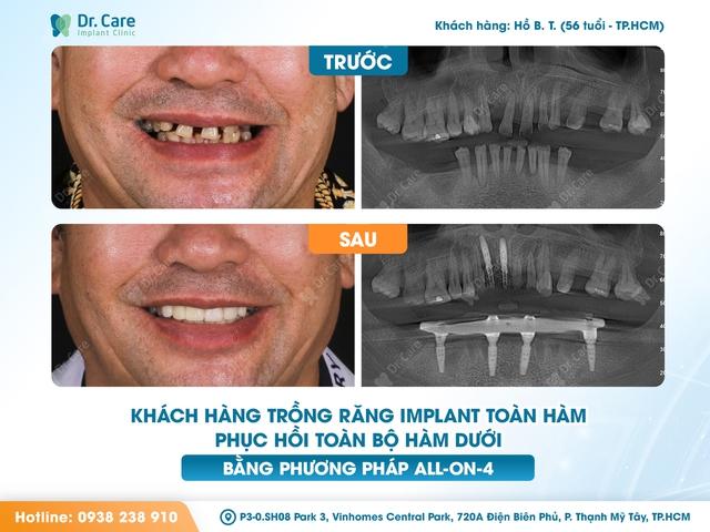 Trồng răng giả nguyên hàm: Giải pháp Implant tiết kiệm tại Dr. Care - Ảnh 1.