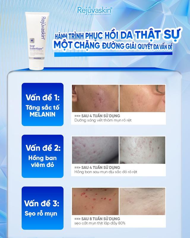 Sẹo thâm, sẹo rỗ lâu năm vẫn cải thiện nhờ cách dùng Scar Esthetique đúng chuẩn này!- Ảnh 3.