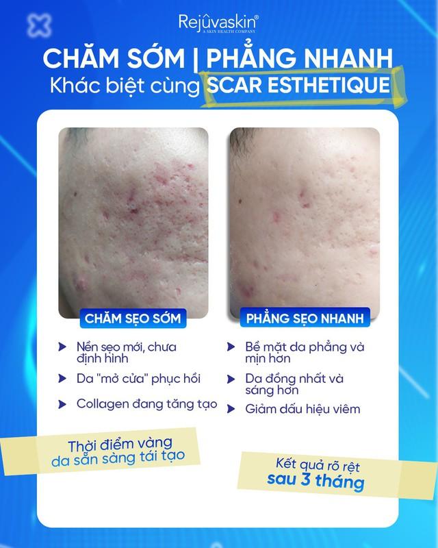 Sẹo thâm, sẹo rỗ lâu năm vẫn cải thiện nhờ cách dùng Scar Esthetique đúng chuẩn này!- Ảnh 7.