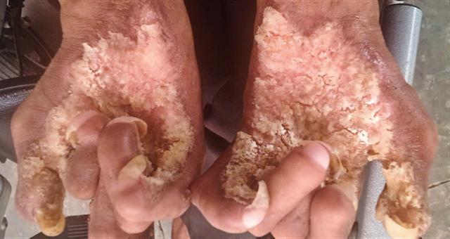 Giải mã bí ẩn bệnh “người cây” hiếm gặp tại Việt Nam - Ảnh 1.