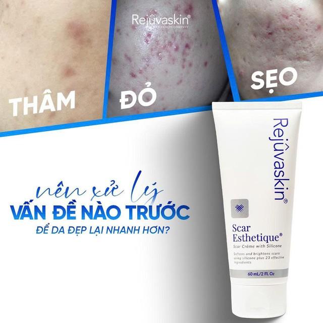 Da mụn breakout: khi nào nên chăm sóc da, khi nào nên đi thẳng đến treatment?- Ảnh 1.