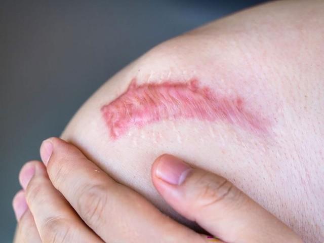 Vì sao chăm sóc vết thương đúng chuẩn giúp giảm sẹo ngay từ đầu? - Ảnh 2.