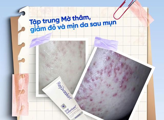Phục hồi da sau mụn đúng thời điểm hạn chế sẹo lõm hình thành như thế nào? - Ảnh 2.