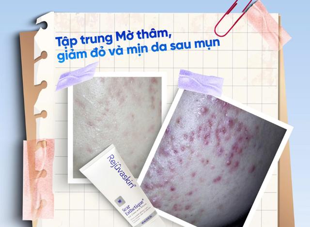 Da mụn breakout: khi nào nên chăm sóc da, khi nào nên đi thẳng đến treatment?- Ảnh 2.