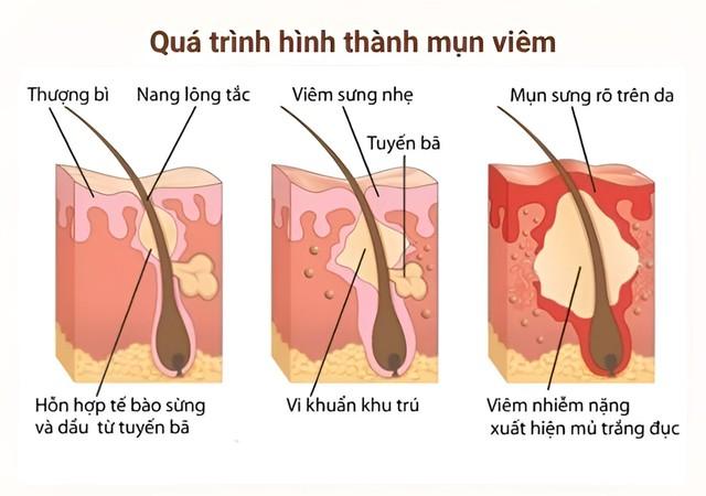 Da sau mụn: Giải mã tiến trình phục hồi sinh học dưới góc độ chuyên gia- Ảnh 2.