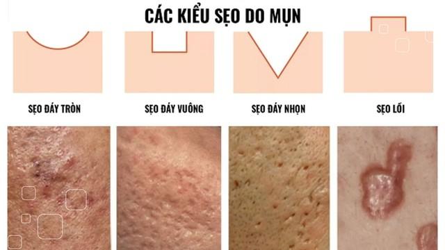 Ghim ngay: Tuýp kem đang được Gen Z ‘vote cao’ cho sẹo mụn! - Ảnh 3.