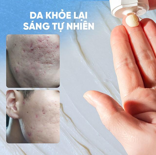 Da sau mụn nhạy cảm kéo dài: Khi hàng rào da chưa thực sự hồi phục - Ảnh 4.