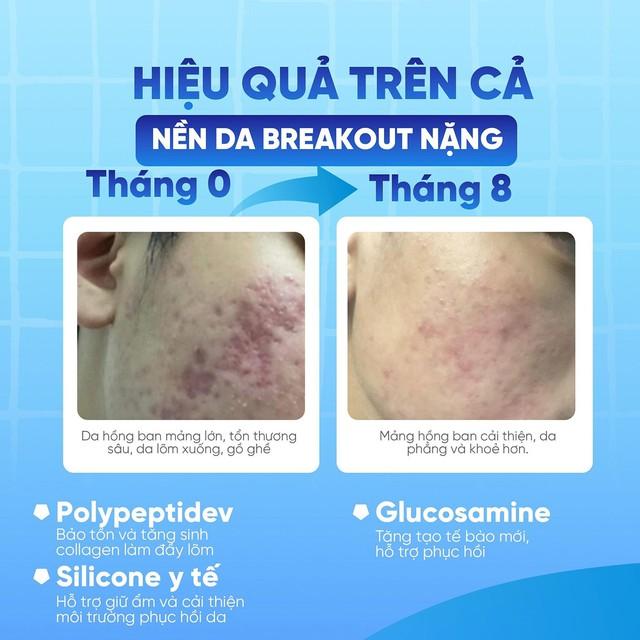Hiệu quả lâm sàng cho thấy công dụng cải thiện nền da sau breakout của Scar Esthetique - Ảnh 4.